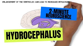 2Minute Neuroscience Hydrocephalus [upl. by Dahcir585]