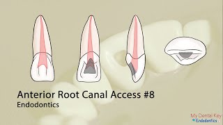 PASS THE CDCA  Anterior Endo Access  My Dental Key [upl. by Arsi]