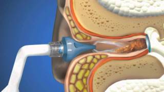 Bionix® OtoClear® Ear Irrigation [upl. by Dysart4]