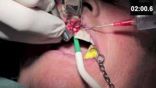 Dental Training  Implant surgery [upl. by Paradies]