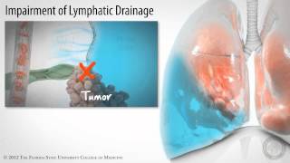 Pleural Space Part 3 of 3 Pleural Effusions HD [upl. by Waligore]