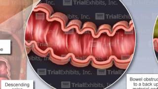 Bowel Perforation [upl. by Auj]