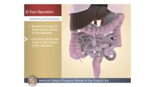 What to Expect • Colonoscopy [upl. by Kinchen]