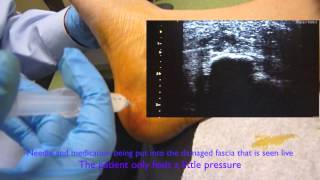 Ultrasound Guided Plantar Fascia Injection [upl. by Brout]