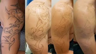 Eliminar tatuajes con láser Antes y después  Borratatu Barcelona [upl. by Billi]