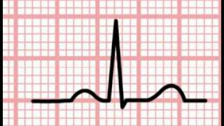 ECG Interpretation  Time and the ECG Section 1 Part 5 [upl. by Gayle]