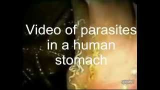 Parasites Infestation in Human Stomach [upl. by Gnihc833]