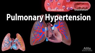 Pulmonary Hypertension Animation [upl. by Eirehc]