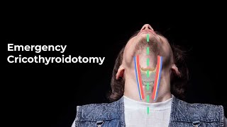 Performing an Emergent Cricothyroidotomy  MEDZCOOL [upl. by Larred]