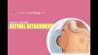 What Causes Retinal Detachment [upl. by Raimund]