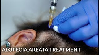 PRP Stem Cells amp Steroid Injections for Alopecia Areata Female Hair Loss Treatment  Dr Jason Emer [upl. by Naehgem]