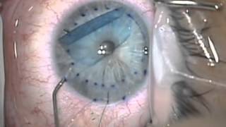 Selective laser trabeculoplasty SLT glaucoma treatment [upl. by Aryl]