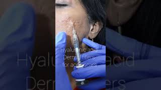 Hyaluronic filler injections for acne scars [upl. by Stelle]