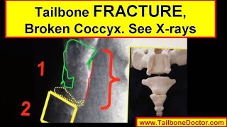 Xrays showing COCCYX FRACTURE broken tailbone [upl. by Odey]