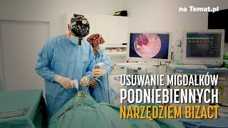 Usuwanie migdałków podniebiennych narzędziem BiZact [upl. by Yerffoej]