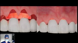 How does a CONNECTIVE TISSUE graft work [upl. by Gut]