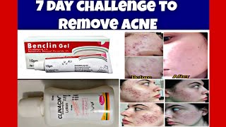 Acneamp acne scar treatment at home 7 DayChallenge to Remove ACNE and scarClindamycin skin care [upl. by Yvonner]