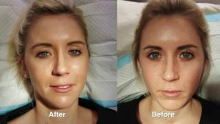 Juvederm rejuvenation w Before amp After Pictures [upl. by Lonier]