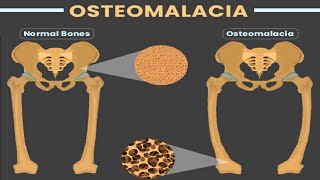 OSTEOMALACIA [upl. by Borg984]