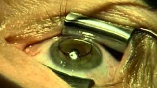 Suprachoroidal Haemorrhage During Cataract Surgery [upl. by Struve]