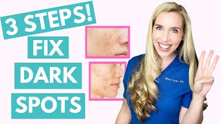 Fix Your Dark Spots in 3 Steps  Hyperpigmentation  Melasma  Skincare Made Simple [upl. by Orianna]