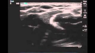 How To Peripheral Arm Veins for Vascular Access Scanning Technique Video [upl. by Salene]