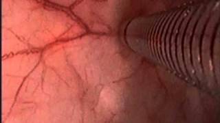 BladderScan BVI9400 Diane Newman Video for Male Patients [upl. by Nomyaw49]