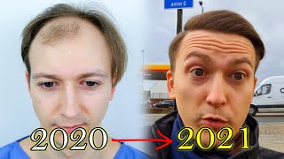 FUE Hair Transplant Growth Timeline  Before amp After [upl. by Cirederf]