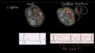 Fibrillation auriculaire  Définition  Impact  Evaluation  Anticoag  HH  FC  Rythme [upl. by Ayalahs]