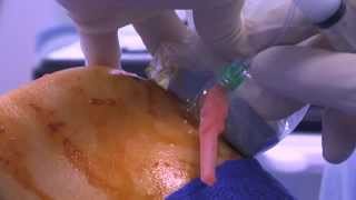 WATCH a Knee Joint Injection  LIVE [upl. by Granniah]