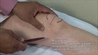 Knee Injection  Medial Approach [upl. by Laeno522]