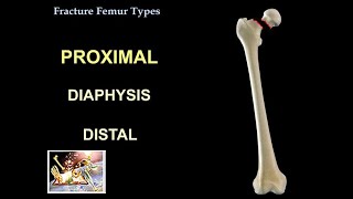 Fracture Femur Types  Everything You Need To Know  Dr Nabil Ebraheim [upl. by Relluf460]