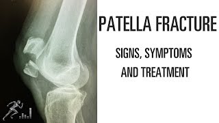 Patella fracture Mechanism of injury signs and symptoms and treatment [upl. by Idnic]