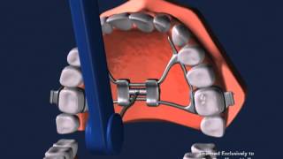 Advanced Orthodontics  Expanders [upl. by Itnahsa26]