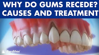 Gum recession  Treatment of gingival retraction © [upl. by Klarika]