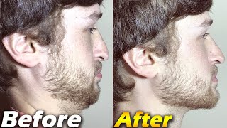 Crazy Jawline Transformation BEFORE and AFTER  Jawline Exercises [upl. by Ruff295]