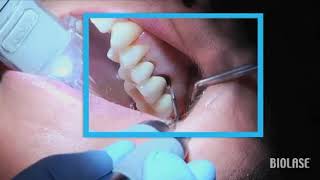 Remoción de caries con lasers Biolase  Streamhealth Dental [upl. by Vihs]