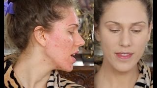 Acne Scar Foundation Routine  Full Coverage Flawless Makeup Tutorial  Pores amp Ice Pick Scarring [upl. by Belcher]