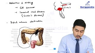 Acute Appendicitis  Causes pathophysiology and clinical features [upl. by Tahp]