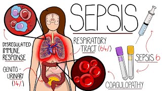 Understanding Sepsis Sepsis Explained Clearly [upl. by Euqnom785]