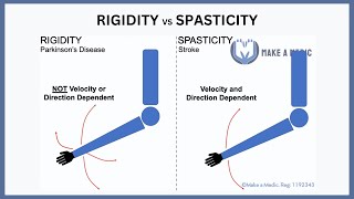 Rigidity vs Spasticity Explained [upl. by Adroj]