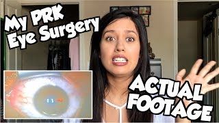 LASIK vs PRK  My PRK Surgery ACTUAL FOOTAGE [upl. by Alisun955]