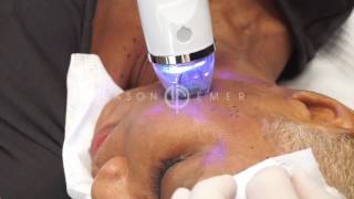 Endymed Intensif RF Micro Needling  Acne Scar Treatment  Pores Treatment  Dr Jason Emer [upl. by Siulesoj]