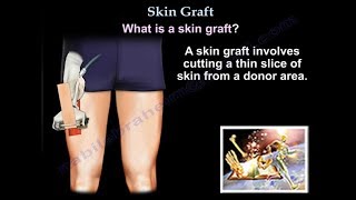 Skin Graft  Everything You Need To Know  Dr Nabil Ebraheim [upl. by Ralli127]