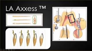 Cirurgia de Acesso ao tratamento Endodôntico  TRATAMENTO DE CANAL [upl. by Winfield]