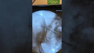 SacroIliac Joint Injection [upl. by Willard]