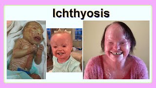 ichthyosis [upl. by Emyaj]