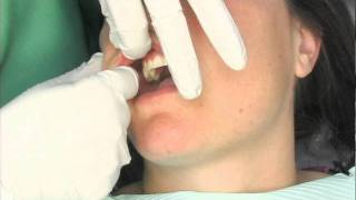 Oral Cancer Screening Exam [upl. by Zizaludba]