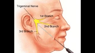 Trigeminal Neuralgia [upl. by Santana]