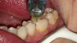 Endodontia de Molar Inferior [upl. by Kimmy]